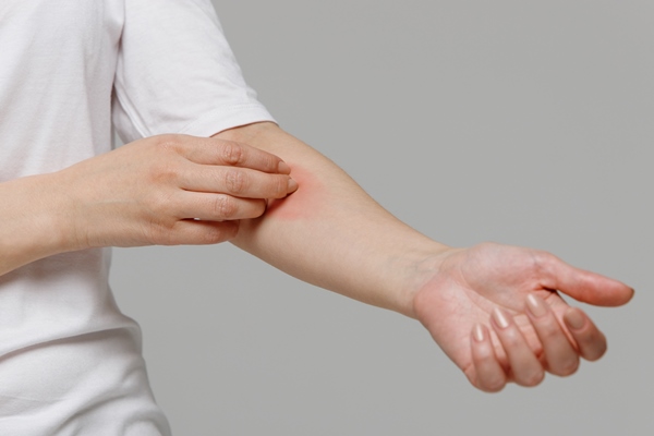 woman scratching the itch on her hand dry skin animal food allergy dermatitis - Бородинский хлеб: история и современность