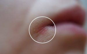 5 e1487273486554 - Заеды, или трещинки в уголках губ: лечение, профилактика