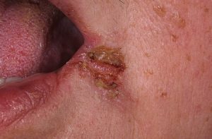 Заеда11 - Заеды, или трещинки в уголках губ: лечение, профилактика