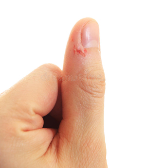 Трещины на пальцах возле ногтей: причины, лечение