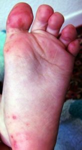 hand foot mouth 1 - Вирус Коксаки: симптомы заболевания, лечение, осложнения