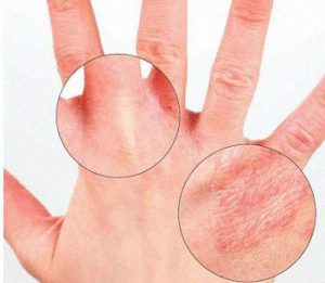 kak otlichit psoriaz ot dermatita - Трещины на пальцах возле ногтей: причины, лечение
