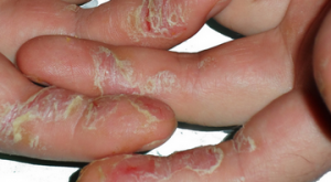treskajutsja ruki do krovi 2 - Трещины на пальцах возле ногтей: причины, лечение