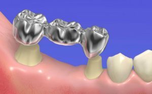 image005 2 - Зубные импланты: виды, показания, особенности