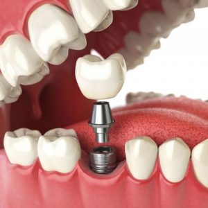 image007 2 - Зубные импланты: виды, показания, особенности
