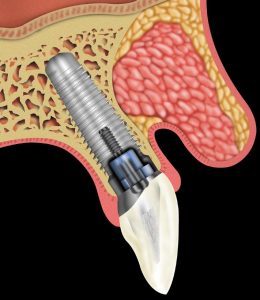 image010 1 - Зубные импланты: виды, показания, особенности
