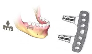 image012 1 - Зубные импланты: виды, показания, особенности