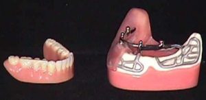 image014 - Зубные импланты: виды, показания, особенности