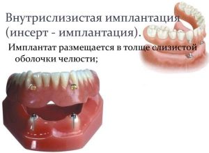 image015 - Зубные импланты: виды, показания, особенности
