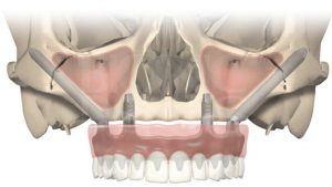image017 - Зубные импланты: виды, показания, особенности