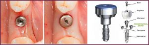 image019 - Зубные импланты: виды, показания, особенности