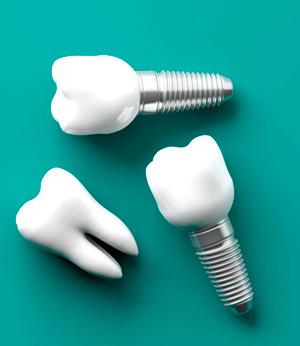 Зубные импланты: виды, показания, особенности